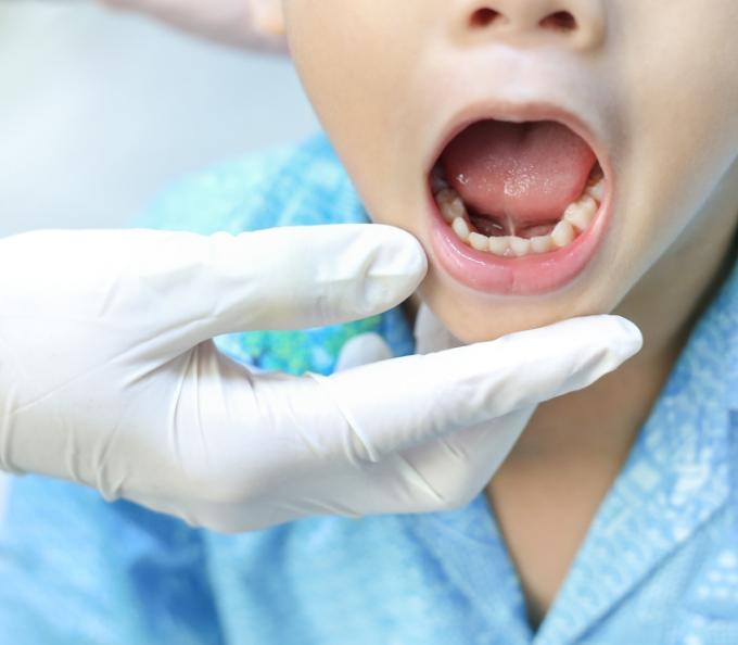 Child opening their mouth wide to show frenulum under tongue