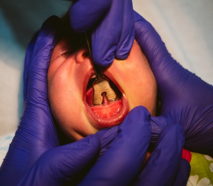 Close up of dentist performing a frenectomy on a baby