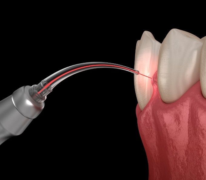 Illustrated laser performing frenectomy