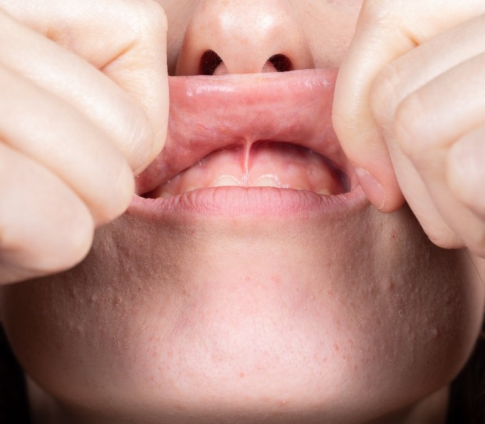 Person stretching their upper lip upward to show frenulum