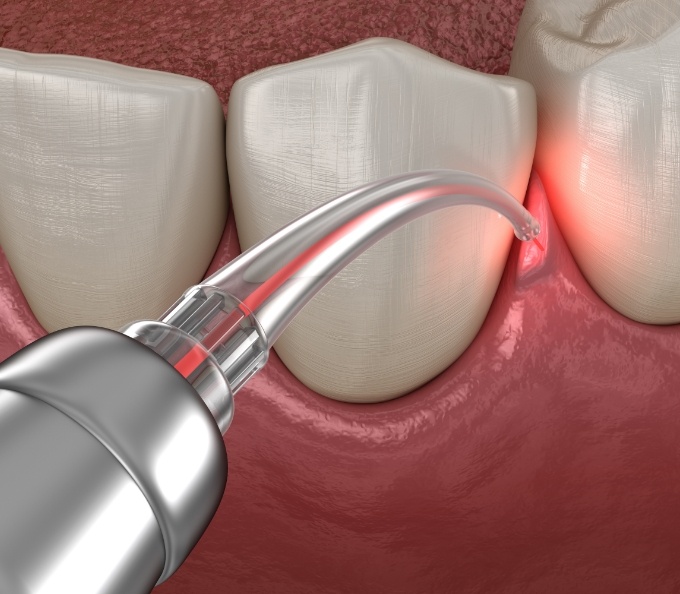 Illustrated dental laser being used during a frenectomy